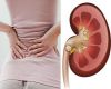 Những dấu hiệu sớm cảnh báo sỏi thận