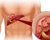 Sỏi đường mật trong gan (sỏi gan)