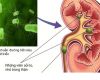 Viêm đường tiết niệu do sỏi điều trị thế nào?