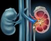 ĐIỀU TRỊ BỆNH SỎI THẬN TẬN GỐC
