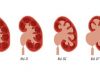Thận ứ nước do sỏi tiết niệu