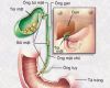 Sỏi mật là gì?