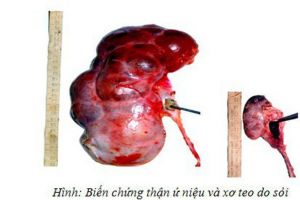Biến Chứng Gây Nguy Hiểm Của Sỏi Thận