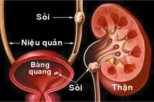 Tư vấn điều trị sỏi 11mm không cần phẫu thuật