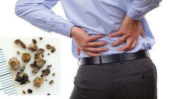 Tôi vừa tán sỏi thận, dùng thuốc này để phòng ngừa được không?