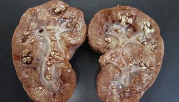 Sỏi san hô có điều trị được không?