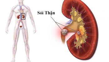 Bệnh sỏi thận có ảnh hưởng đến sinh sản không?